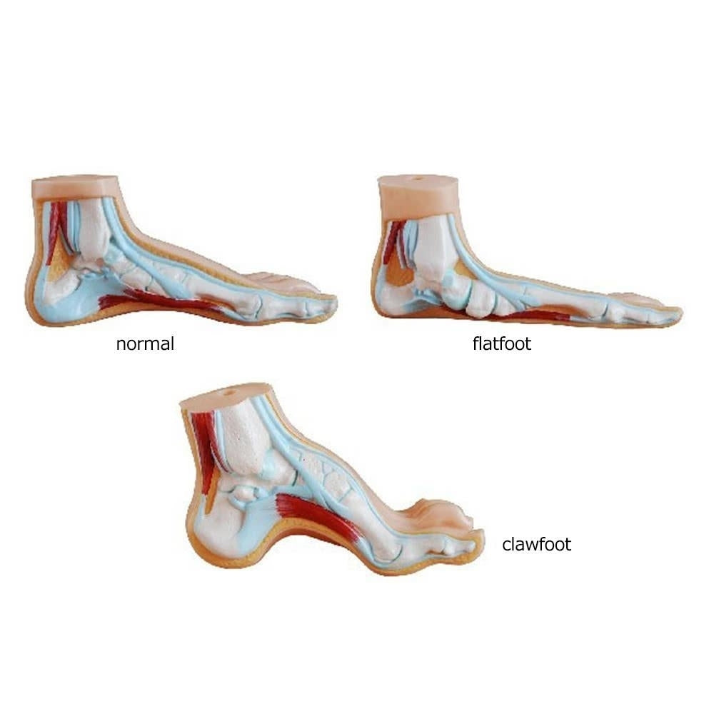 1 Pair Flat Feet Orthotic Plantar Fasciitis Arch Support Sleeve Cushion Pad Heel Spurs Foot Care Image 4