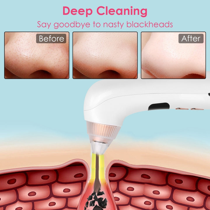 Electric Blackhead Remover with 30X Camera and Hot Compress Technology White Image 4