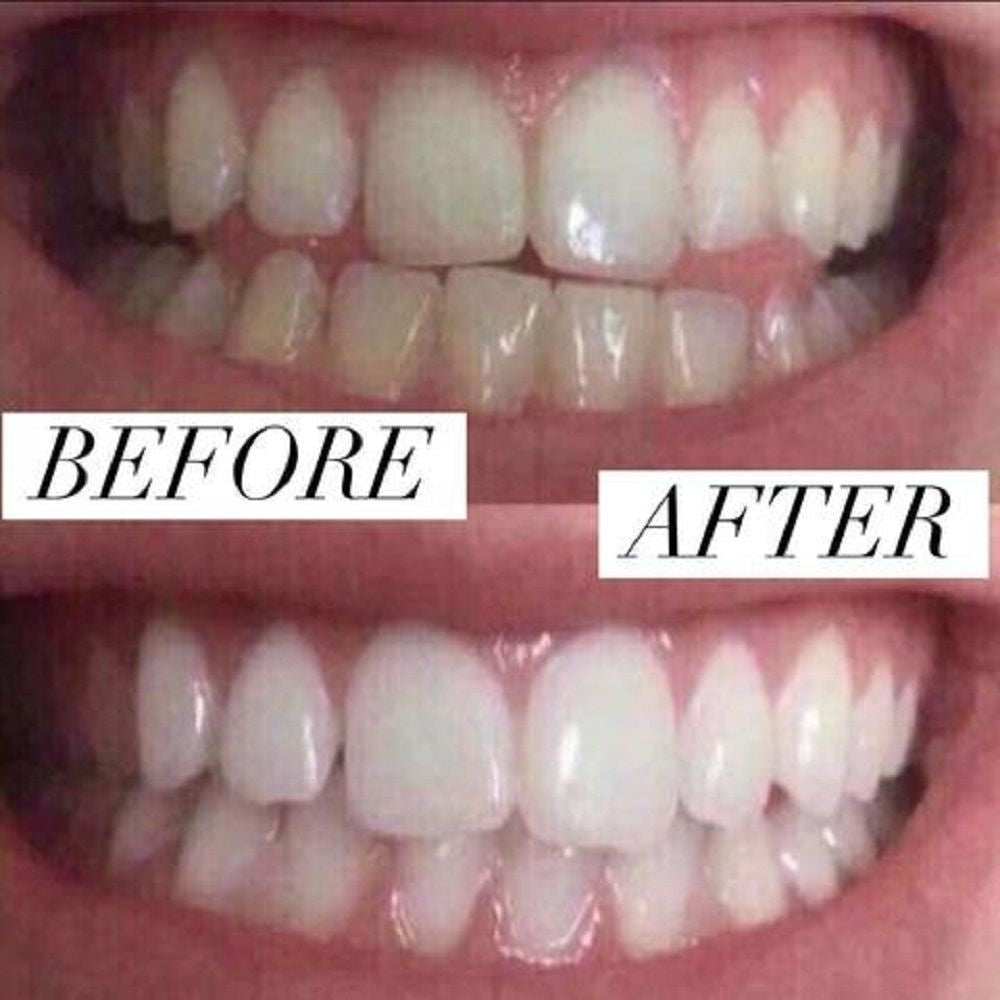 Home Teeth Whitening 3D System and Free Remineralization Gel Image 2