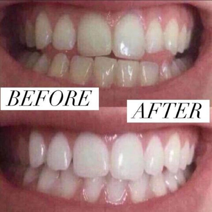 Home Teeth Whitening 3D System and Free Remineralization Gel Image 1