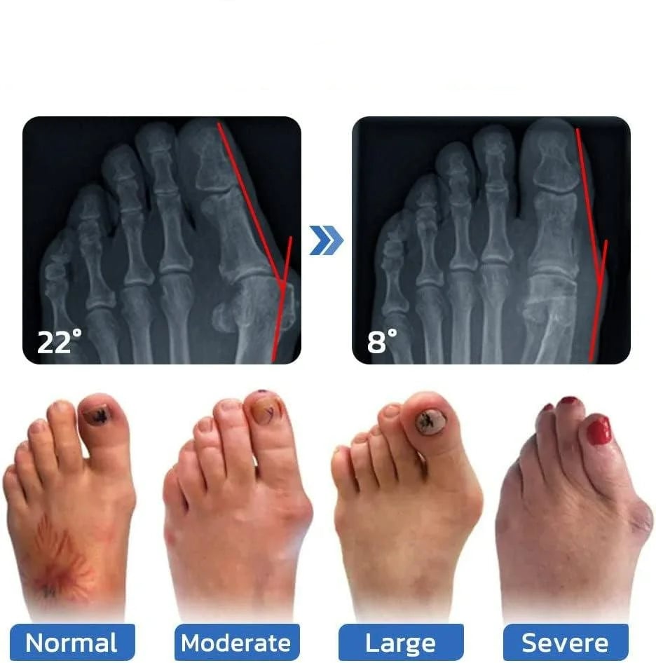 Anti-Bunion and Vein Health Socks for Women and Men Image 3