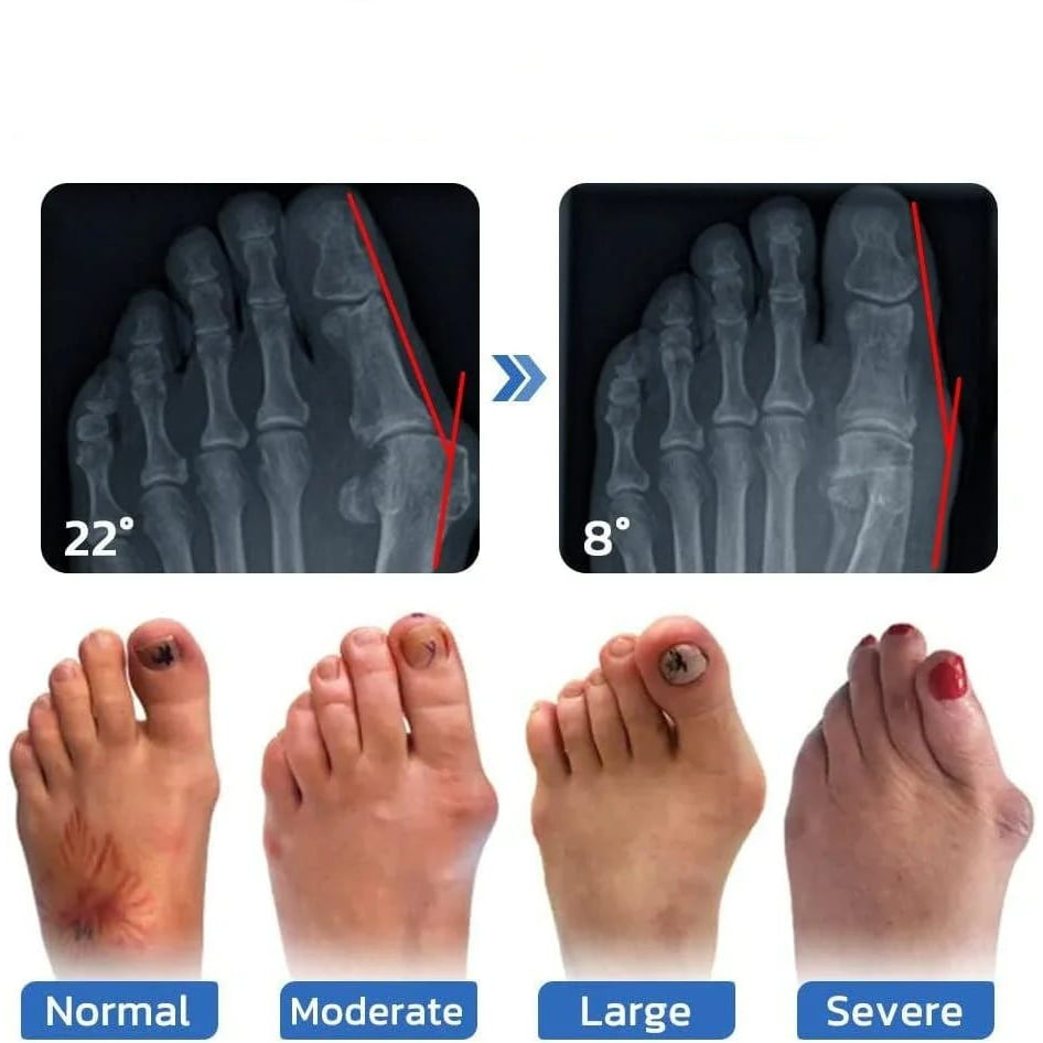 Anti-Bunion and Vein Health Socks for Women and Men Image 10