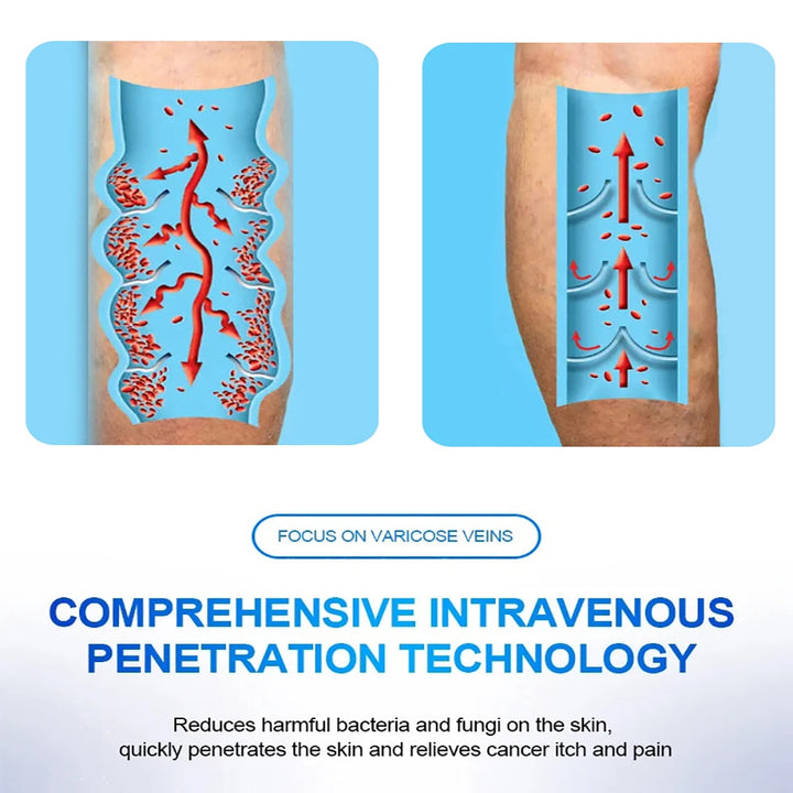 Varicose Vein Lampshade Therapy Effective Relief Of Dilated Vasculitis In The Legs Phlebitis Improved Blood Circulation Image 4